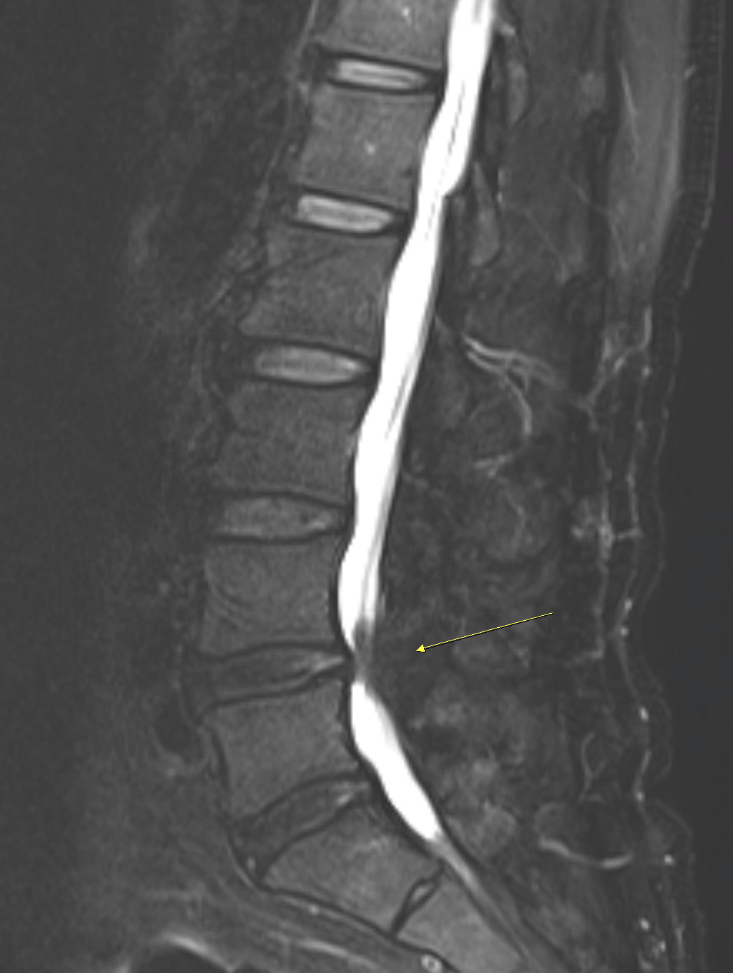 腰椎第四第五節處嚴重狹窄壓迫神經 MRI 影像